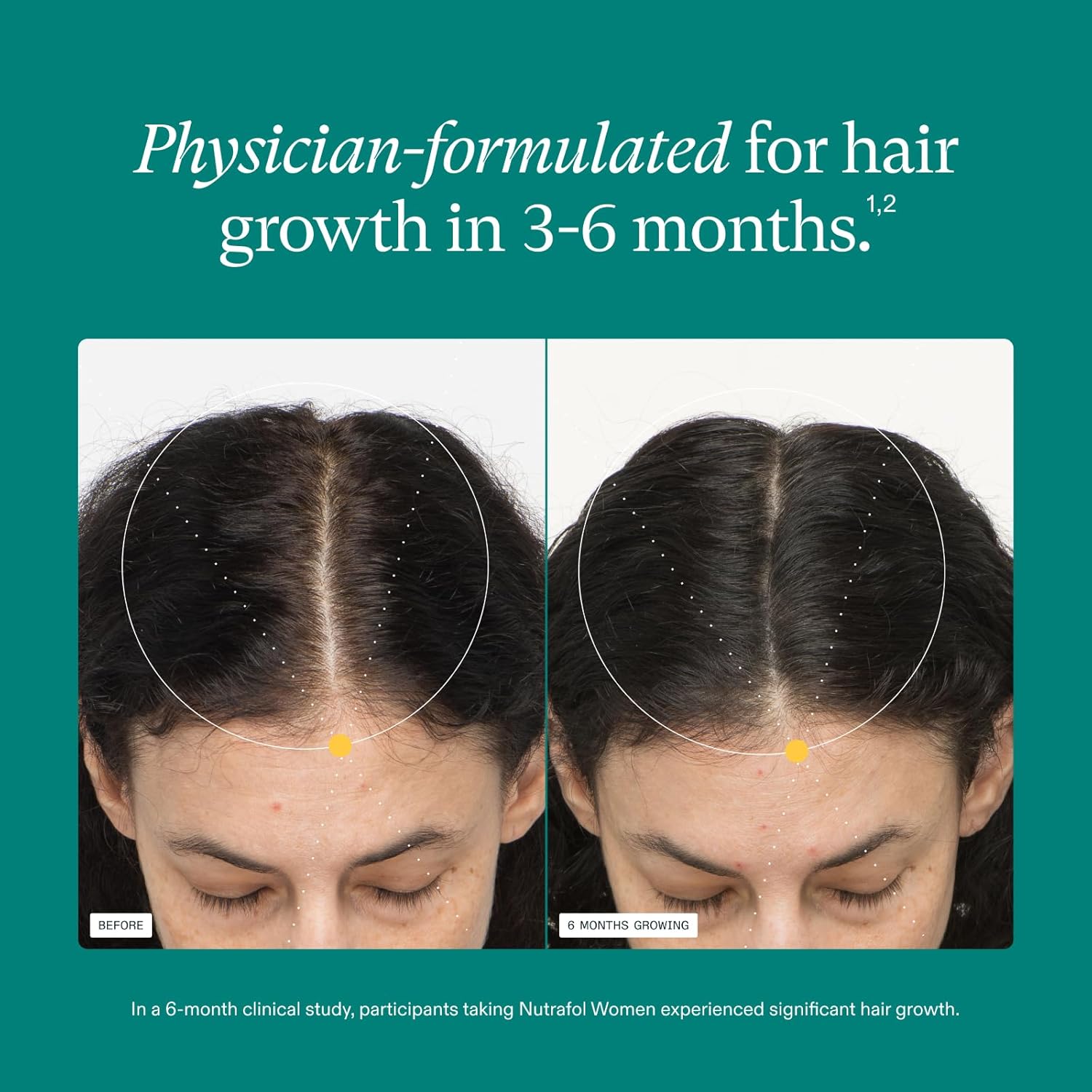 Nutrafol Women's Hair Growth SupTLements, for Women Ages 18-44, Clinically Proven Hair SupTLement for Visibly Thicker and Stronger Hair, Dermatologist Recommended - 1 Month SupTLy, 1 Refill Pouch